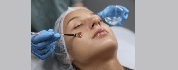 peeling-quimico